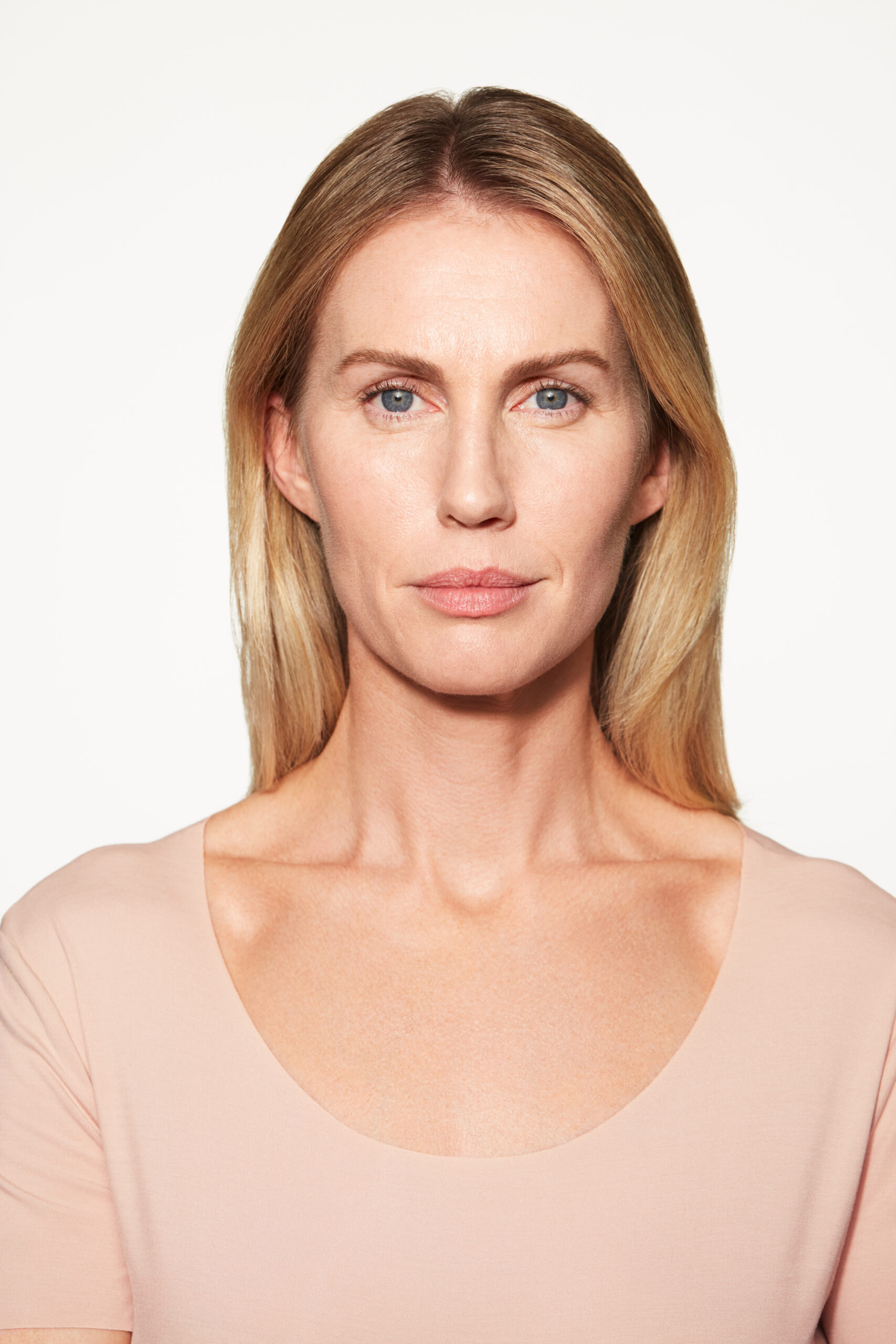 Chloe Sculptra Cheek 3 Mo After Facing Forward