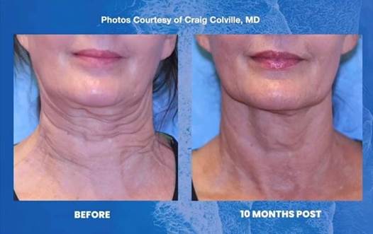 SofWave Skin Tightening